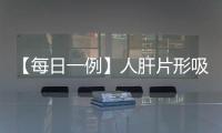 【每日一例】人肝片形吸蟲病