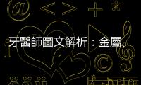 牙醫師圖文解析：金屬、金屬燒瓷、全瓷，這些假牙材質究竟有什麼差別？