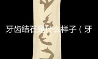 牙齒結石是什么樣子（牙結石是什么樣子的）