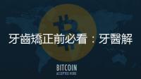牙齒矯正前必看：牙醫解析門診時最常被詢問的七項疑難雜癥