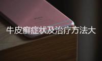 牛皮癬癥狀及治療方法大揭秘