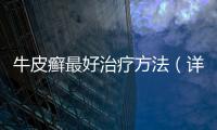 牛皮癬最好治療方法（詳解牛皮癬的治療方案）