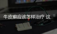 牛皮癬應該怎樣治療 這些方法和技巧有效緩解牛皮癬