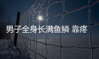 男子全身長滿魚鱗 靠疼痛止癢從小被看成怪物孤立無援