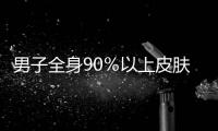 男子全身90％以上皮膚莫名潰爛險喪命幕后真兇竟然是…