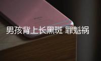 男孩背上長黑斑 罪魁禍首居然是它
