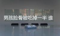 男孩臉骨被吃掉一半 誰說牙疼不是病？