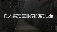 真人實拍去眼袋的前后全歷程
