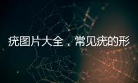 疣圖片大全，常見疣的形態和治療方法