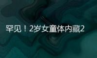 罕見！2歲女童體內藏2.6厘米結石