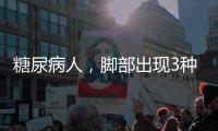 糖尿病人，腳部出現(xiàn)3種癥狀，不能拖，或是糖尿病足的前兆