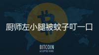 廚師左小腿被蚊子叮一口潰爛一年 原是靜脈曲張所致