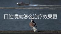 口腔潰瘍怎么治療效果更好？