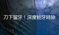 刀下留牙！深度蛀牙時除了根管治療，還可嘗試「活髓保存術」？
