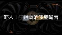 嚇人！王祖藍(lán)曬潰瘍嘴唇腫得像豐過唇