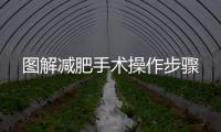 圖解減肥手術操作步驟