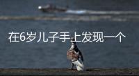 在6歲兒子手上發現一個疤，說是在學校被狗咬的？園方：可能是臆想