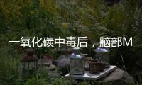 一氧化碳中毒后，腦部MRI是這樣的
