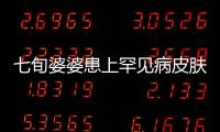 七旬婆婆患上罕見病皮膚變硬如“鐵布衫”