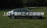 上瞼下垂矯正術(shù)后眼睛睜不開
