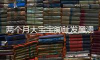 兩個月大寶寶腳趾發黑潰爛 都是頭發惹的禍