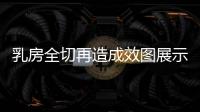乳房全切再造成效圖展示:乳房重建手術疤痕不顯,胸部還跟原來一樣大