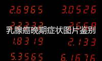乳腺癌晚期癥狀圖片鑒別,乳腺癌晚期癥狀實例解析