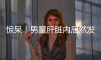 驚呆！男童肝臟內(nèi)居然發(fā)現(xiàn)繡花針