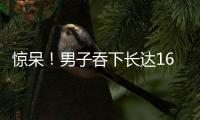驚呆！男子吞下長達16厘米的毛衣針