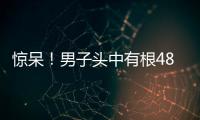 驚呆！男子頭中有根48毫米長釘子