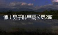 驚！男子肺里藏長(zhǎng)寬2厘米豬骨達(dá)5年