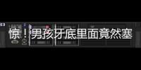 驚！男孩牙底里面竟然塞著繡花針鉛筆芯