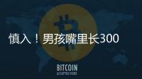 慎入！男孩嘴里長300顆牙 多齒癥真的存在