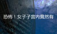 恐怖！女子子宮內竟然有66個肌瘤