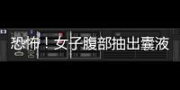 恐怖！女子腹部抽出囊液17000ml