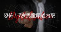 恐怖！7歲男童尿道內取出4.7厘米鐵釘