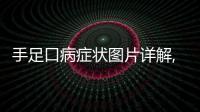 手足口病癥狀圖片詳解,如何預防和治療手足口病