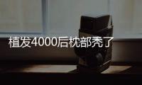 植發4000后枕部禿了真怕人,事實是植發4k單位后枕部會稀疏但不至于禿