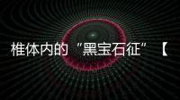 椎體內的“黑寶石征”【YXZX102】