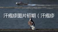 汗皰疹圖片初期（汗皰疹圖片）