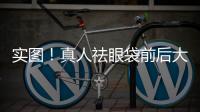 實(shí)圖！真人祛眼袋前后大對(duì)比