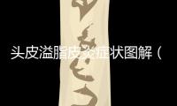 頭皮溢脂皮炎癥狀圖解（頭皮溢脂皮炎癥狀圖）