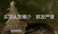 頭頂頭發稀少，脫發嚴重脫怎么辦？滋森漫為你的頭發保駕護航