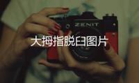 大拇指脫臼圖片