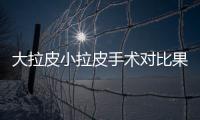 大拉皮小拉皮手術(shù)對比果，誰的果更勝一籌？教你選！