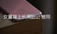 女童背上長(zhǎng)滿胎記 被同學(xué)孤立最終退學(xué)