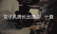 女子乳房長出濕疹，一查卻是乳腺癌？早期哪些異常，女性可得警惕