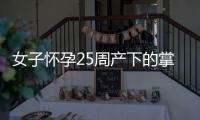 女子懷孕25周產下的掌心寶寶 目前已順利出院