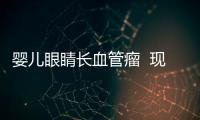 嬰兒眼睛長血管瘤  現在眼睛睜不開
