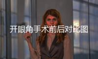 開眼角手術前后對比圖